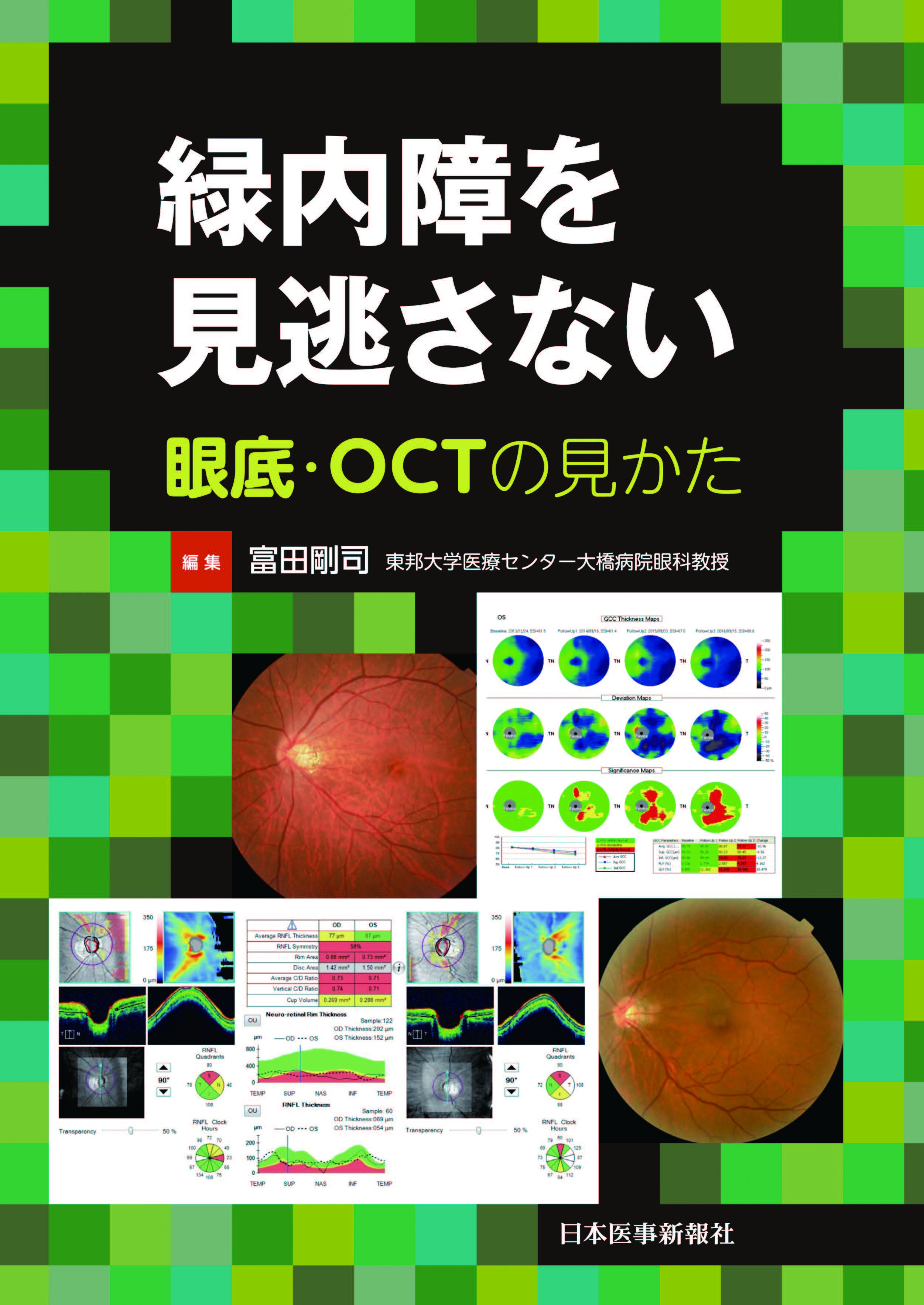 緑内障を見逃さない: 眼底・OCTの見かた [書籍]