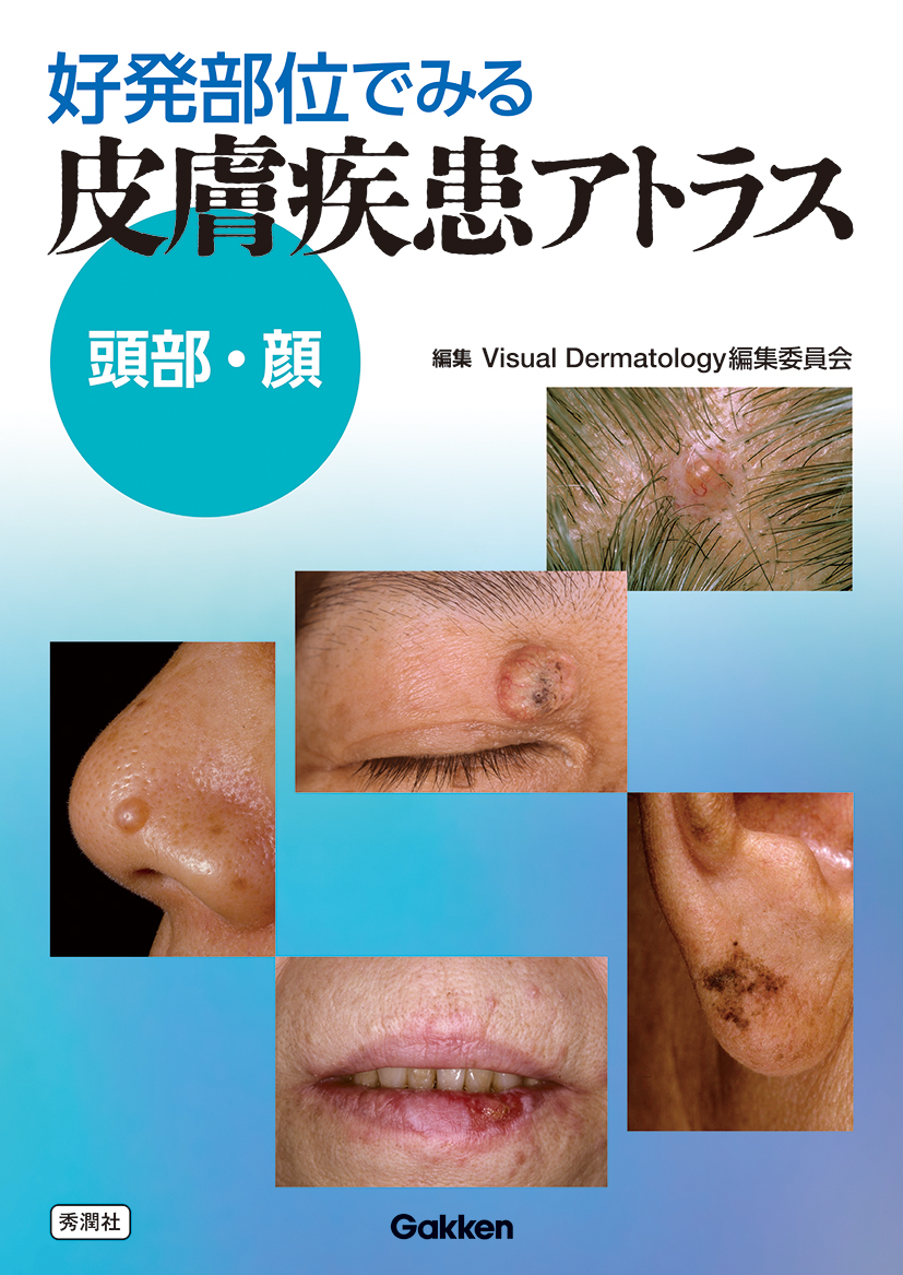 好発部位でみる皮膚疾患アトラス 頭部・顔 | 医書.jp