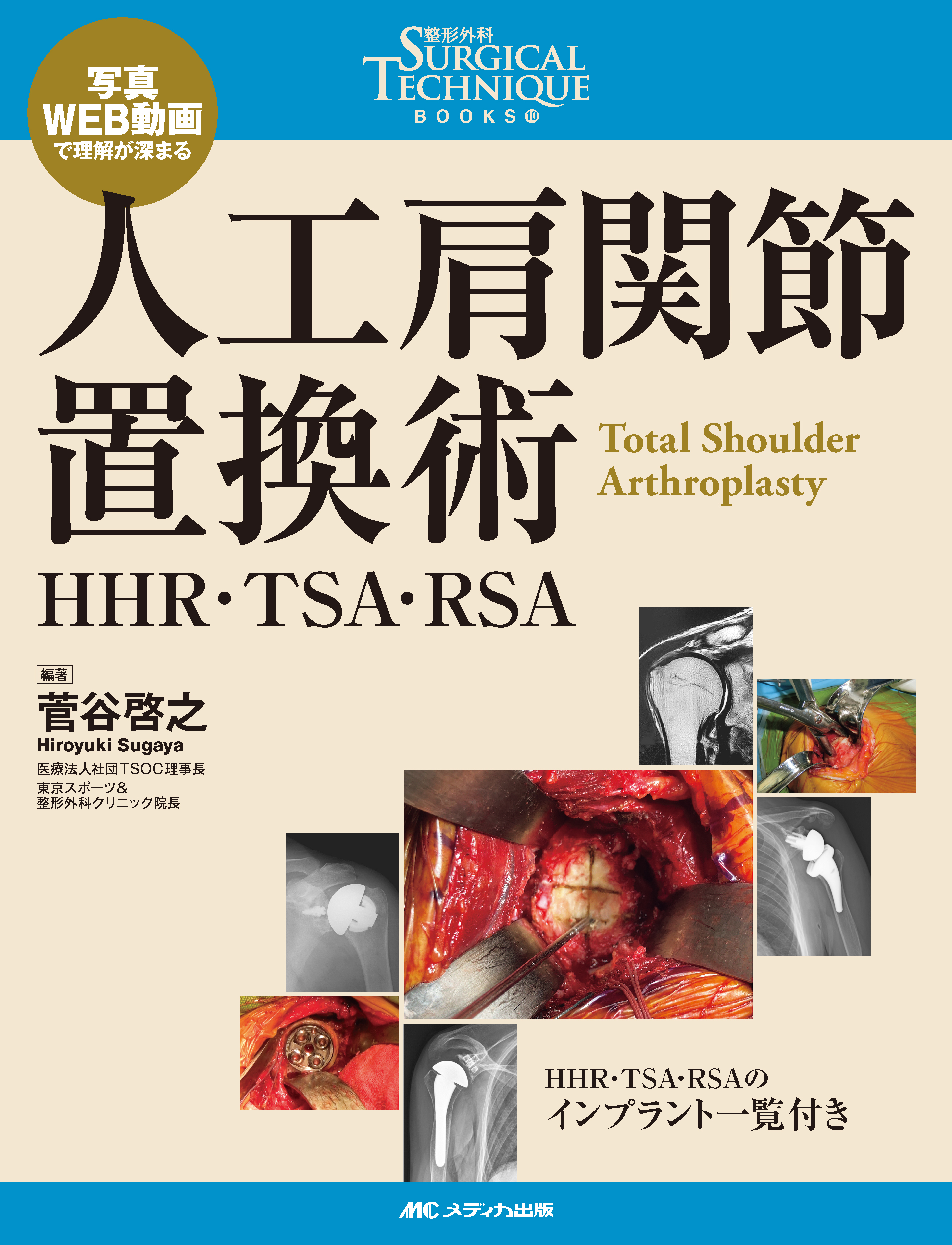 人工肩関節置換術 | 医書.jp
