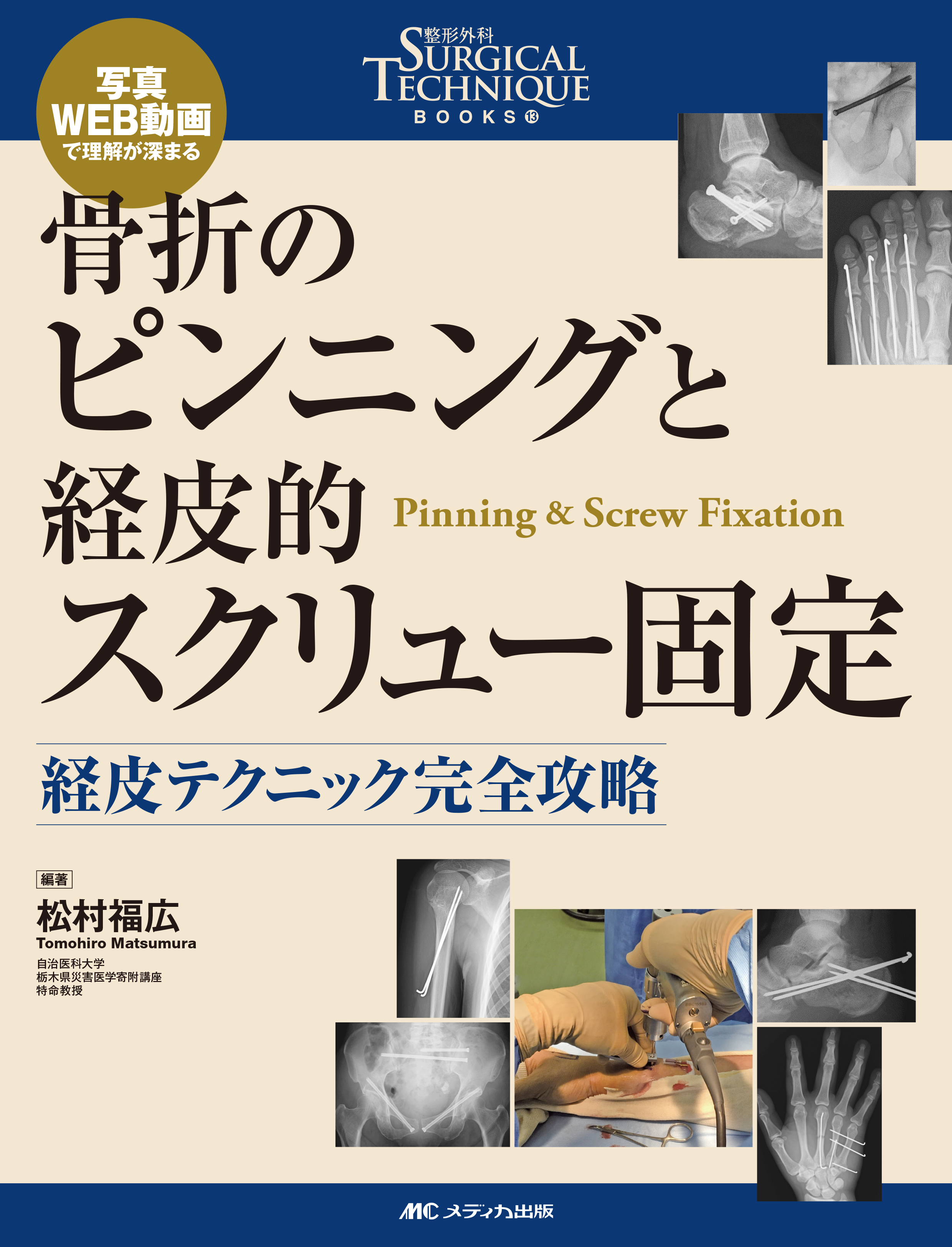 骨折のピンニングと経皮的スクリュー固定 骨折のピンニングと経皮的スクリュー固定 | 医書.jp