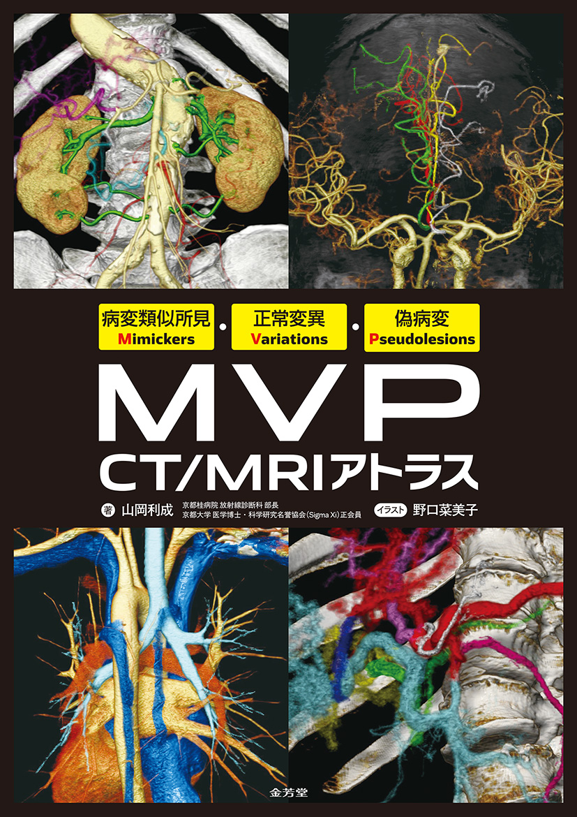 病変類似所見Mimickers・正常変異Variations・偽病変Pseudolesions MVP