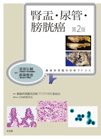 【裁断済み】腎盂・尿管・膀胱癌 腎盂・尿管・膀胱癌 第2版 | 医書.jp